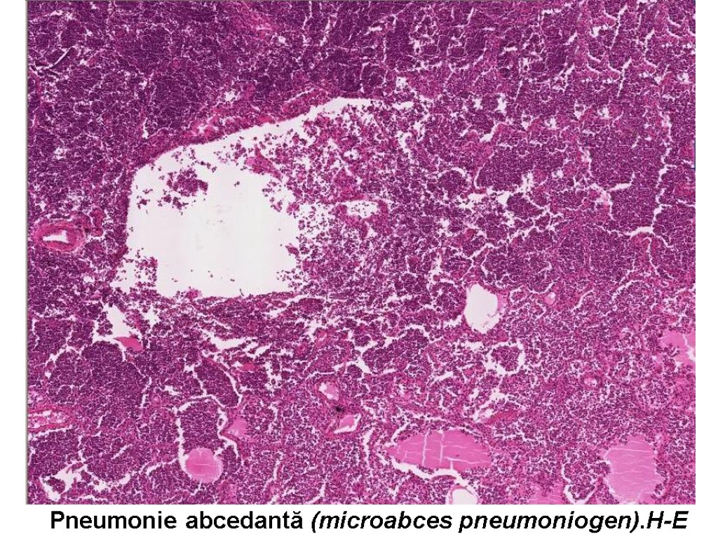 Pneumonie abcedantă (microabces pneumoniogen).H-E